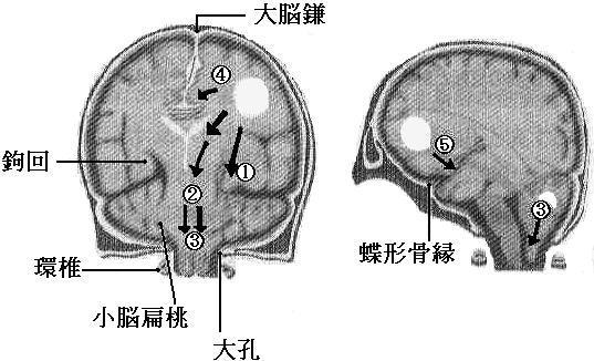 症状 脳 ヘルニア 脳神経外科の病気：腰椎椎間板ヘルニア