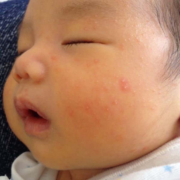 ブツブツ 赤ちゃん 顔 【新生児も】赤ちゃんの顔に赤いぶつぶつができた・・これって何？