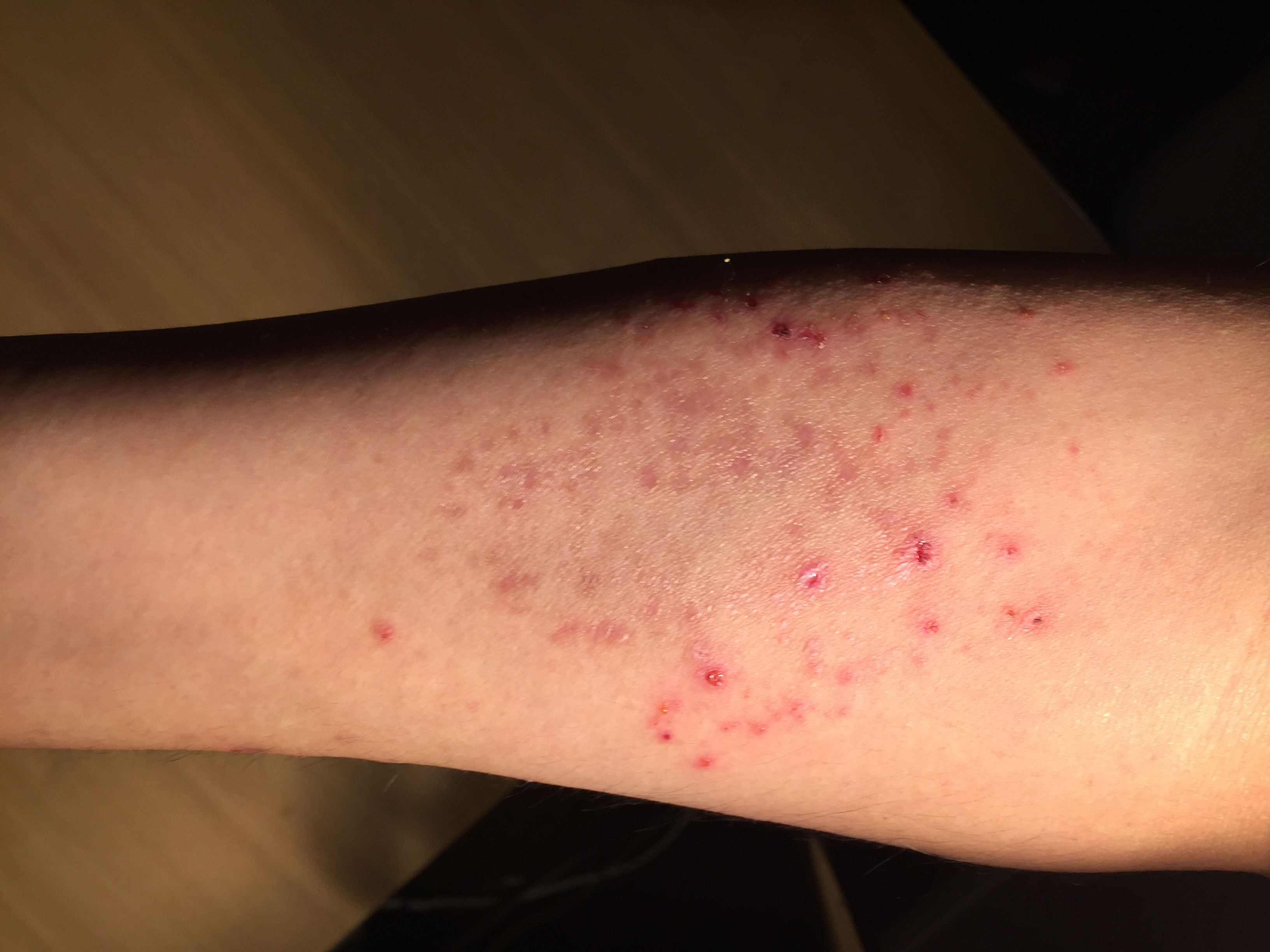 アレルギー性皮膚炎の効果確認 5日目 自然治癒 Natural healing power 楽天ブログ