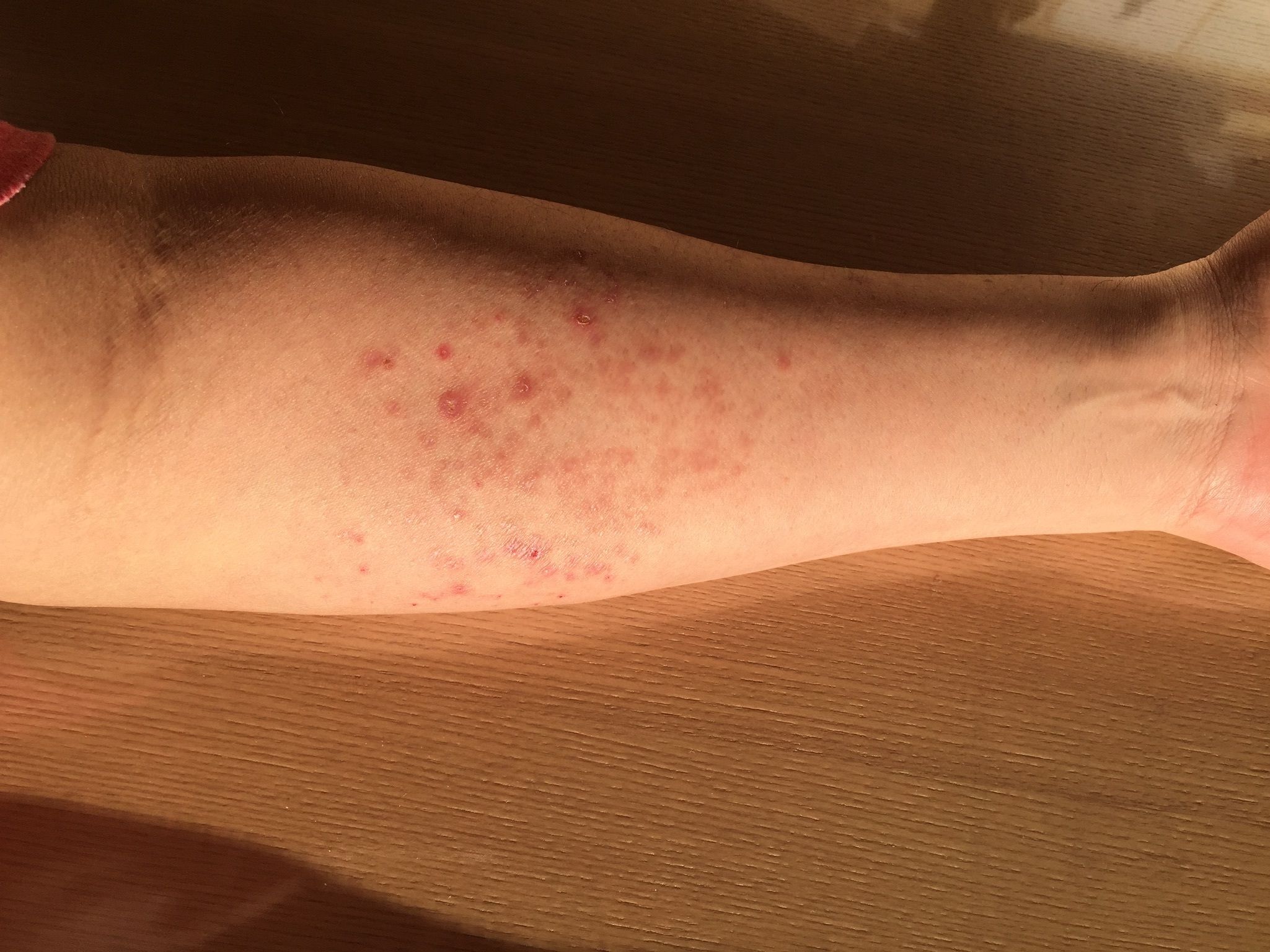 アレルギー性皮膚炎の効果確認 5日目 自然治癒 Natural healing power 楽天ブログ