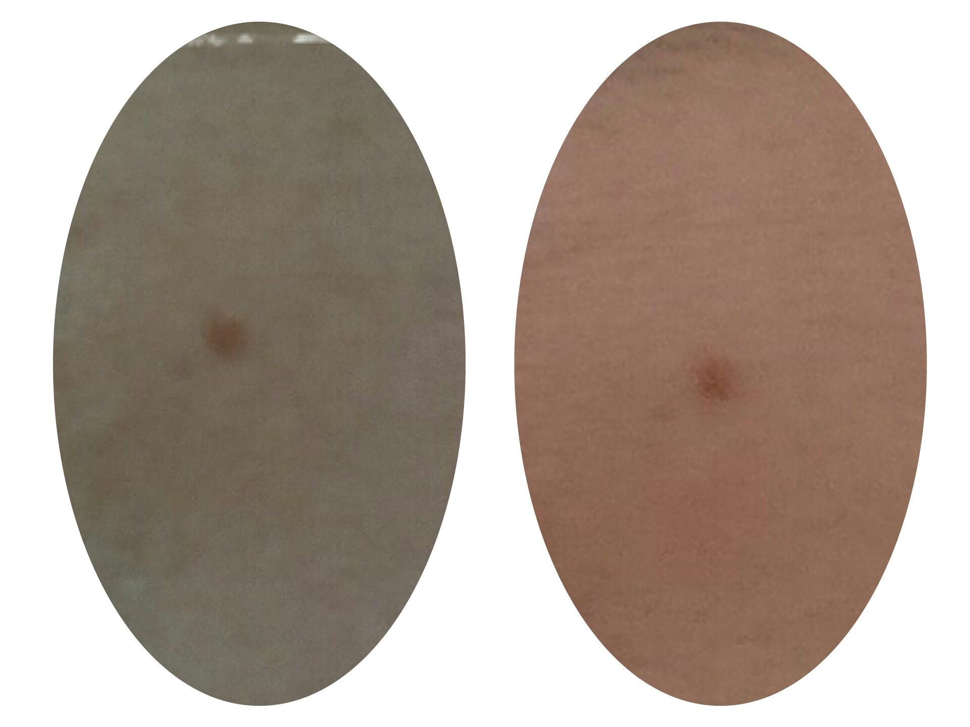 シミが消える メコゾーム ブライトニングフォーミュラ Mako S 美容 Diary 楽天ブログ