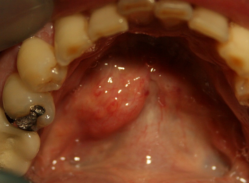 今日の外科手術 201269 preope 唾石症! Hatada Dental Clinic Oral surgery & Implant 楽天ブログ 今日の外科手術 201269 preope 唾石症! Hatada Dental Clinic Oral surgery & Implant 楽天ブログ