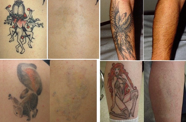 タトゥー 刺青を消したい人 Dr Tattoff のレーザー除去が救世主になる 愛すべき道具達 楽天ブログ