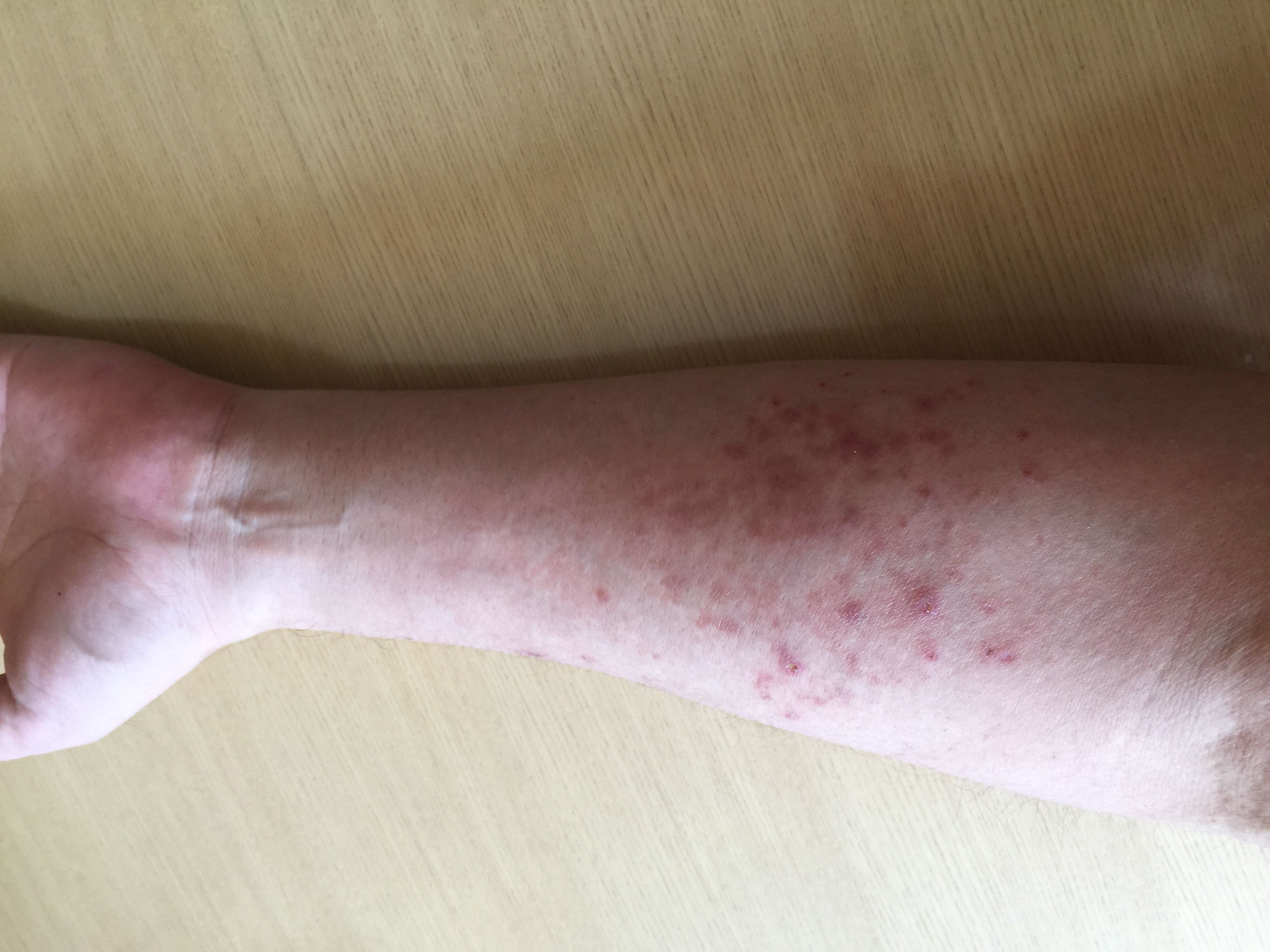 アレルギー性皮膚炎の効果確認 6日目 自然治癒 Natural healing power 楽天ブログ