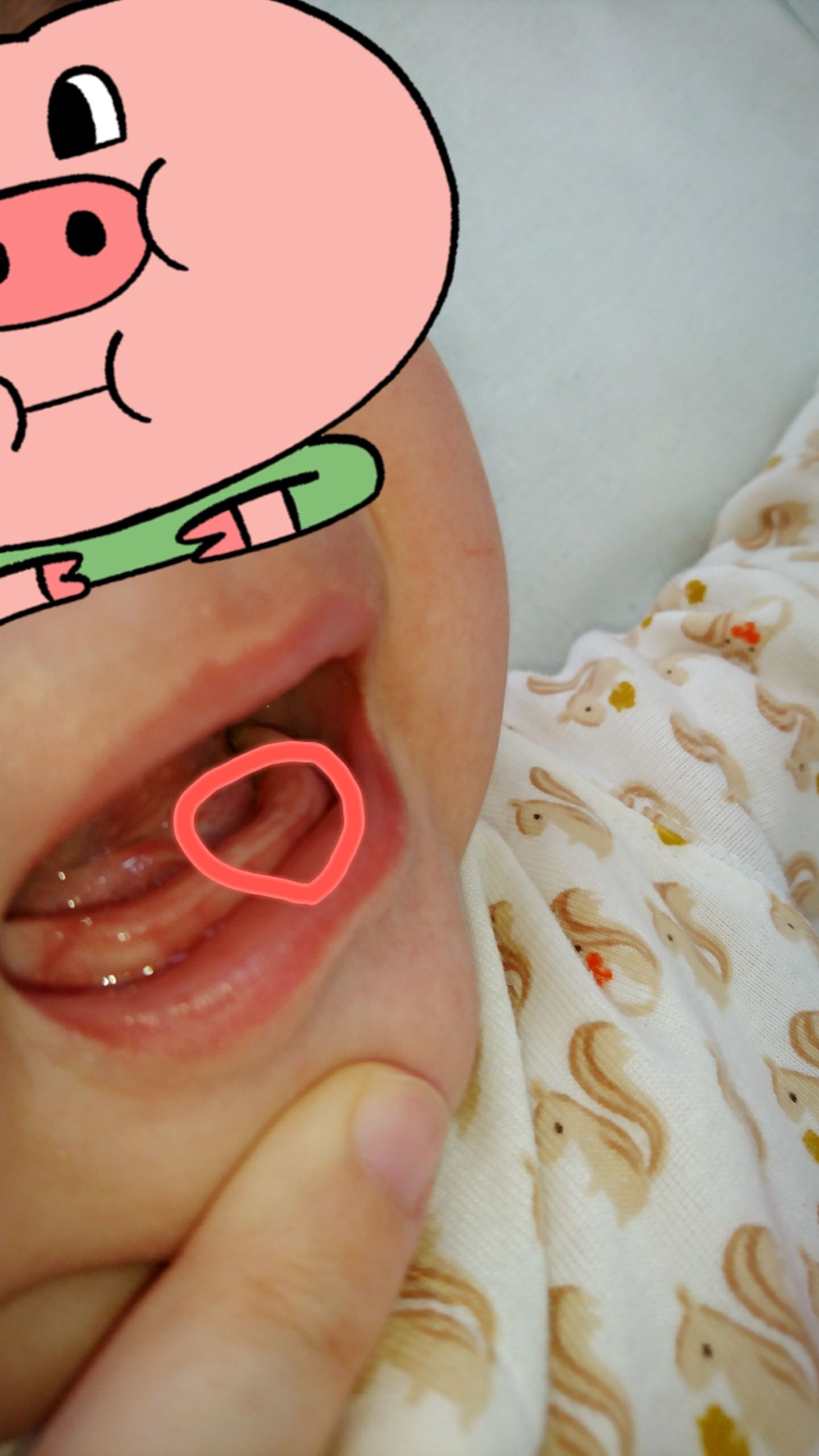 白い 点 歯茎 赤ちゃん 新生児の歯茎の白い点や粒の正体は？3つの可能性