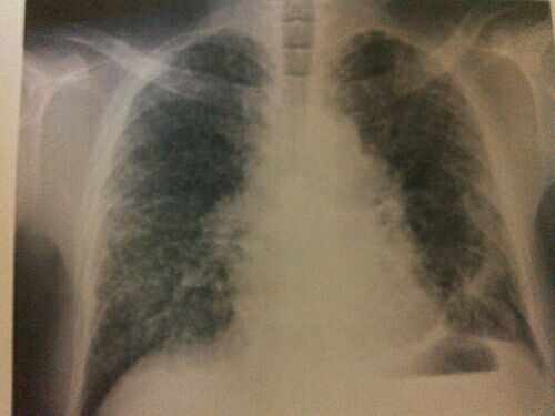 肺がん ステージ 4 ブログ