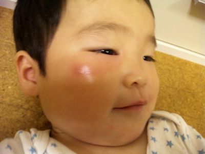 顔が腫れちゃったよ 虫さされ 1歳9ヶ月 Atelier ベビlife 神奈川おでかけ日記 楽天ブログ