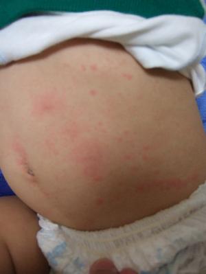 ぶつぶつ 溶連菌 子供の発疹が全身にあるけど熱はない、赤いぶつぶつは溶連菌？