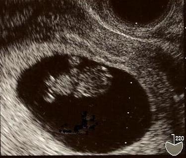 嚢 いつまで 卵黄 卵黄嚢(ｴﾝｼﾞｪﾙﾘﾝｸﾞ)について質問です‥現在妊娠9週ですが、