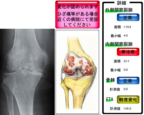 変形性関節症.jpg