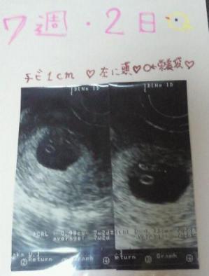 妊娠7週目の胎芽の様子 妊娠二ヶ月の赤ちゃんのエコー写真 ママと赤ちゃんの妊娠カレンダー Baby Room 楽天ブログ