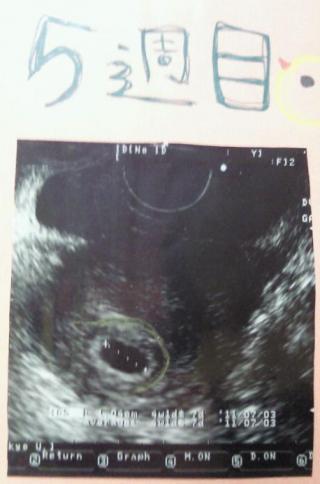 妊娠5週目の赤ちゃん 胎芽 のエコー写真 ママと赤ちゃんの妊娠カレンダー Baby Room 楽天ブログ