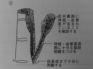 Oblique traiangular flap | 形成外科医のアメリカ留学計画 - 楽天ブログ