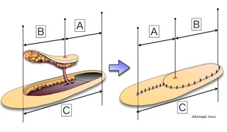 10/08/06 論文/上肢におけるプロペラ皮弁の有用性 形成外科医のアメリカ留学計画 楽天ブログ