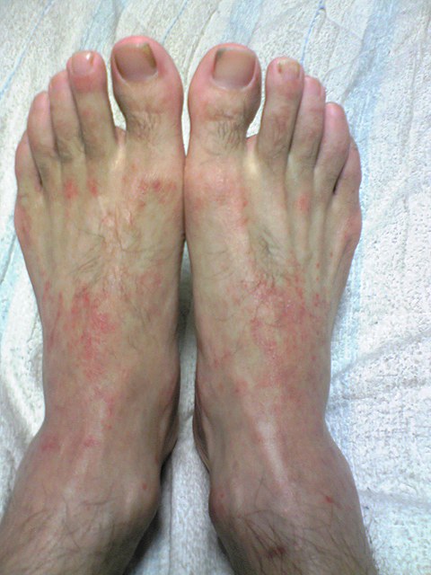 足 の 甲 赤い 斑点