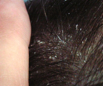 フケ 赤ちゃん 頭皮 赤ちゃんの頭皮の乾燥やフケ対策は何どうやって保湿すればいい？