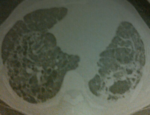 ステージ ブログ 肺がん 4 肺がんステージ４の余命と生きるために必要な情報と治療は？