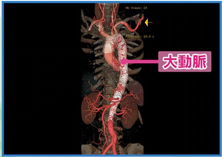 化 大動脈 石灰