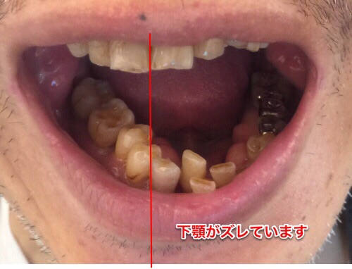 現状維持が最善の方法。開口障害を補う。万能開口器。事故の後遺症あれこれno-35 | 今日のドズル・頸髄損傷・車椅子生活 - 楽天ブログ