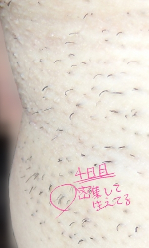 レーザー脱毛 お買い物 美容レビュー 楽天ブログ レーザー脱毛 お買い物 美容レビュー 楽天ブログ