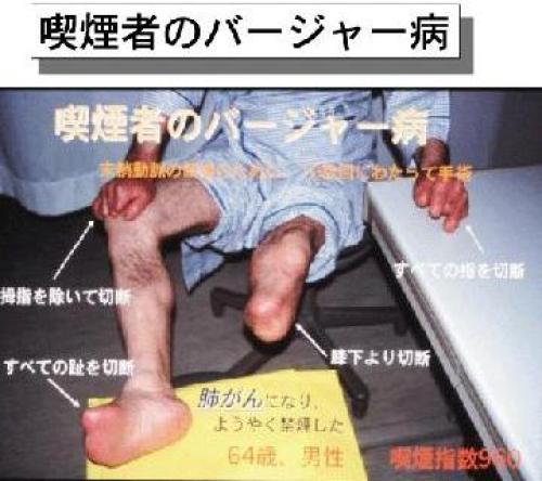 バージャー病