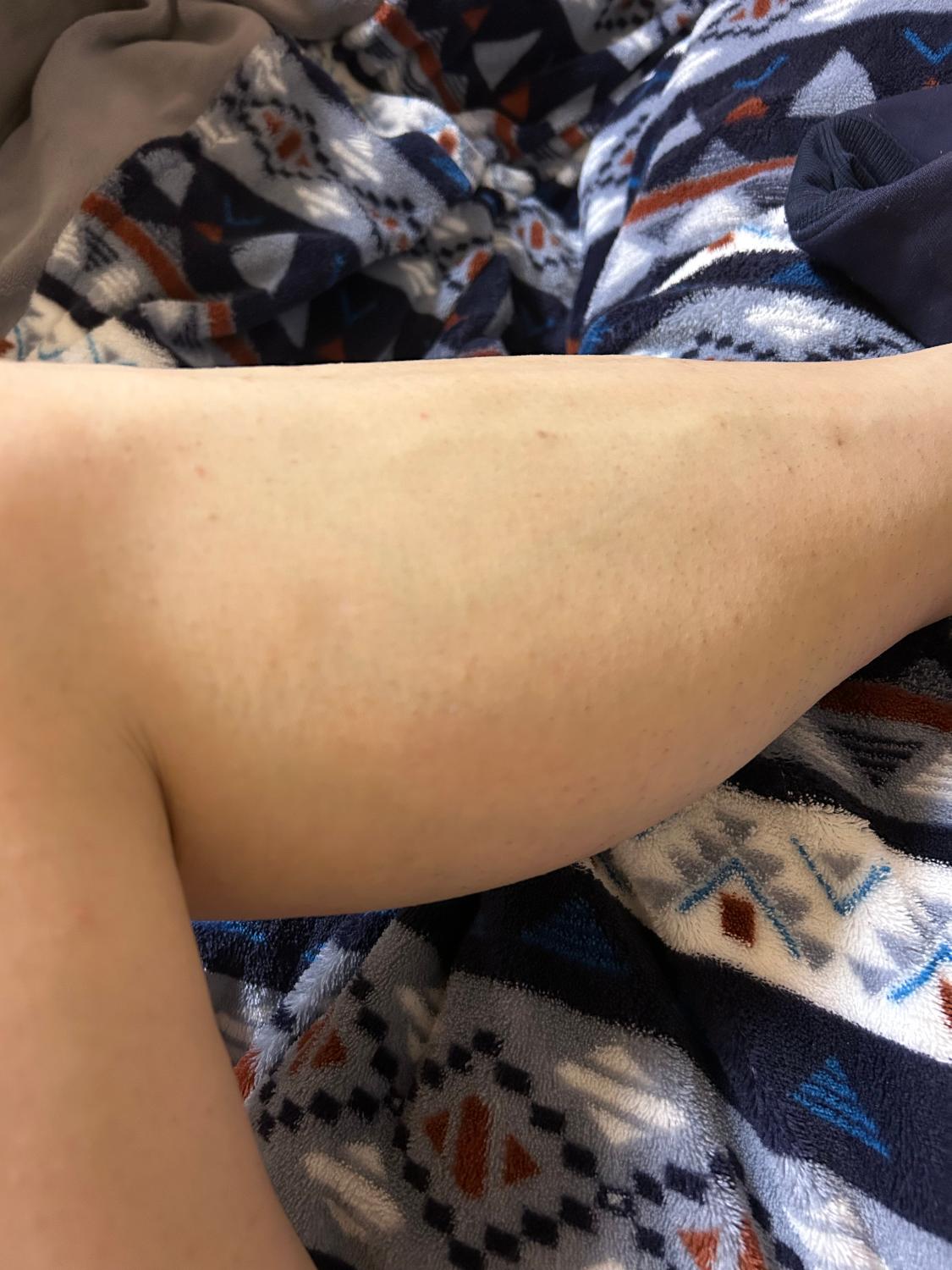 ケノン 脱毛器 口コミ レビュー画像12