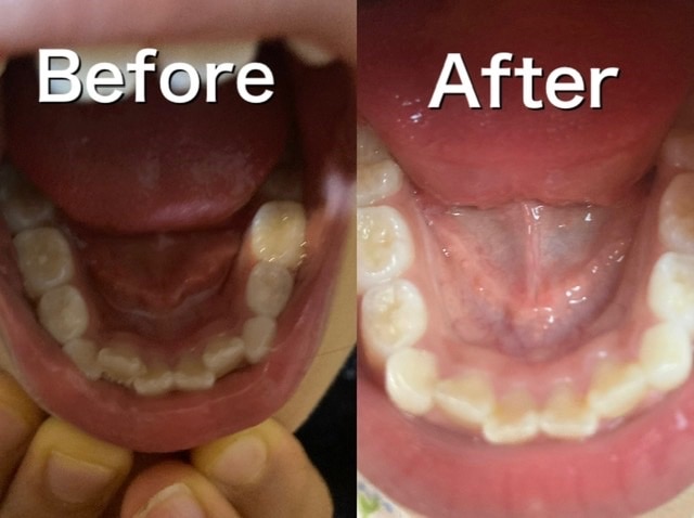 楽天市場 子供用 Premium Smile ソフト ハード セット販売 歯列ケア 子供 キッズ マウスピース 鼻呼吸 口呼吸防止 いびき マウスピース キッズ 子ども 幼児向け 舌 矯正 前 の トレーニング 予防 対策 マウスピース専門店のスマイル みんなのレビュー 口コミ