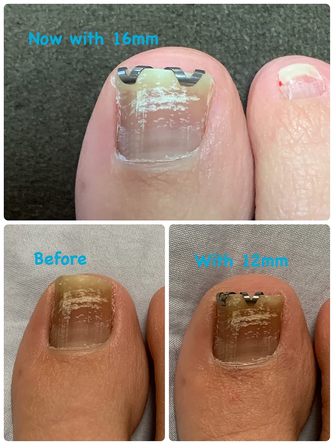 楽天市場 巻き爪 自分で 巻き爪矯正 ネイル エイド ミニ 12mm クリップ ワイヤー ガード 痛い巻き爪 ブロック テープ ロボ 靴 やすり 巻爪 対策 12mm 巻き爪 陥入爪治療の相談室 みんなのレビュー 口コミ