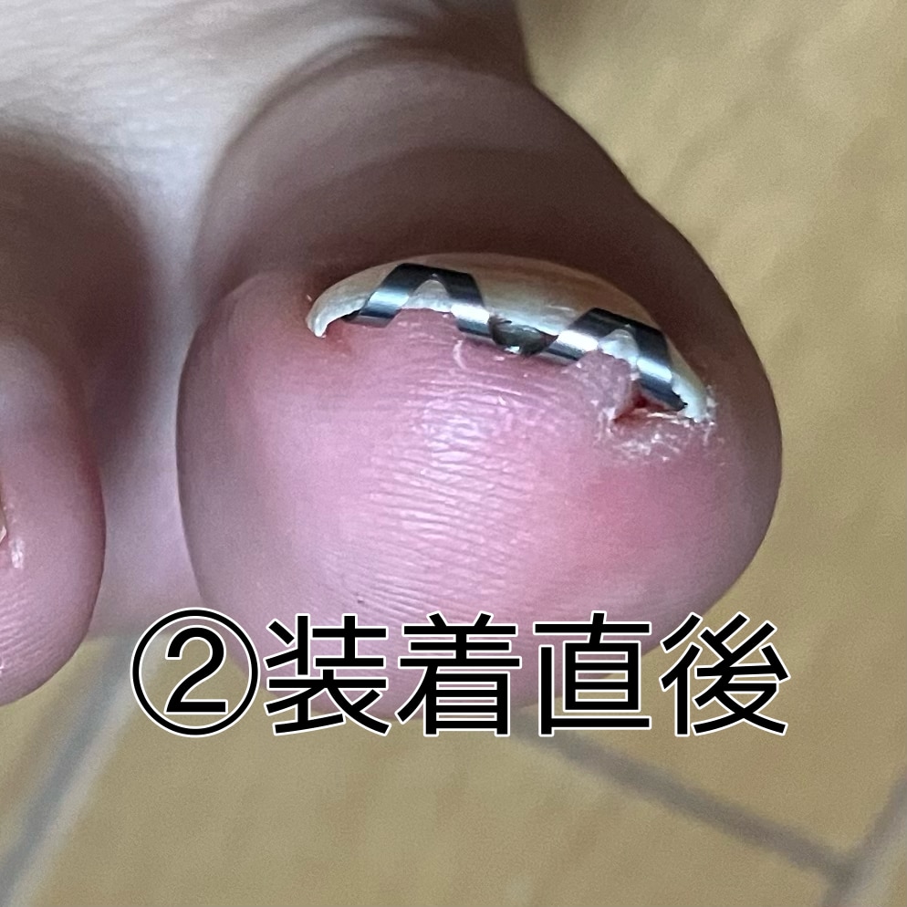 楽天市場】購入者さんさんの巻き爪 自分で 巻き爪矯正 【 ネイル