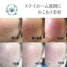 ボタニカルピールlevel7 3セット 楽天市場】ボタニカルピール Level7 3回分 エステジェル セット