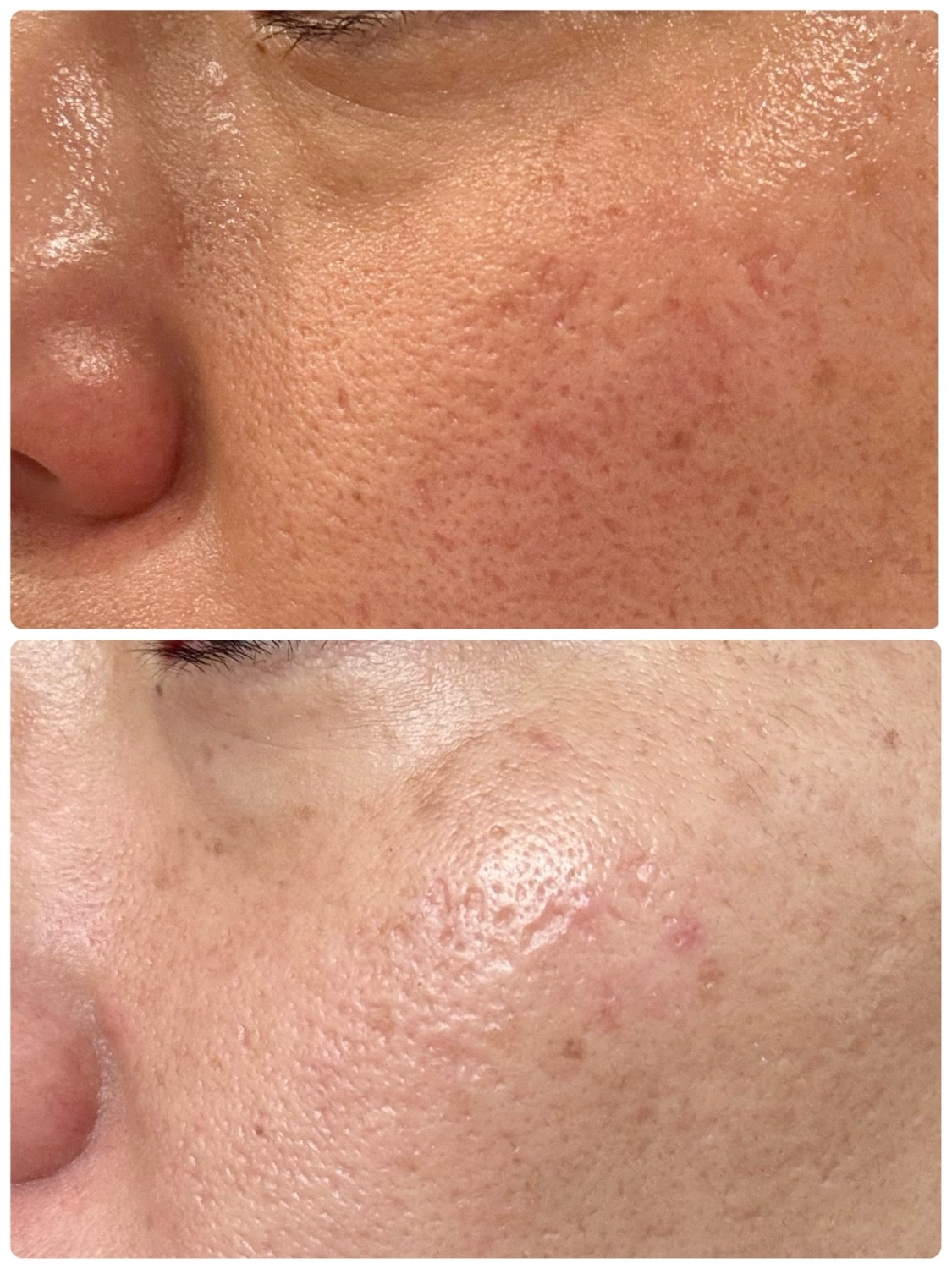 楽天市場】☆5000円クーポン+毛穴セラム☆ 楽天1位 美顔器 韓国