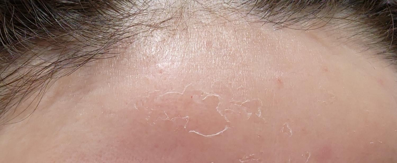 楽天市場】ボタニカルピール Level 7 1回分 ハーブピーリング 剥離あり