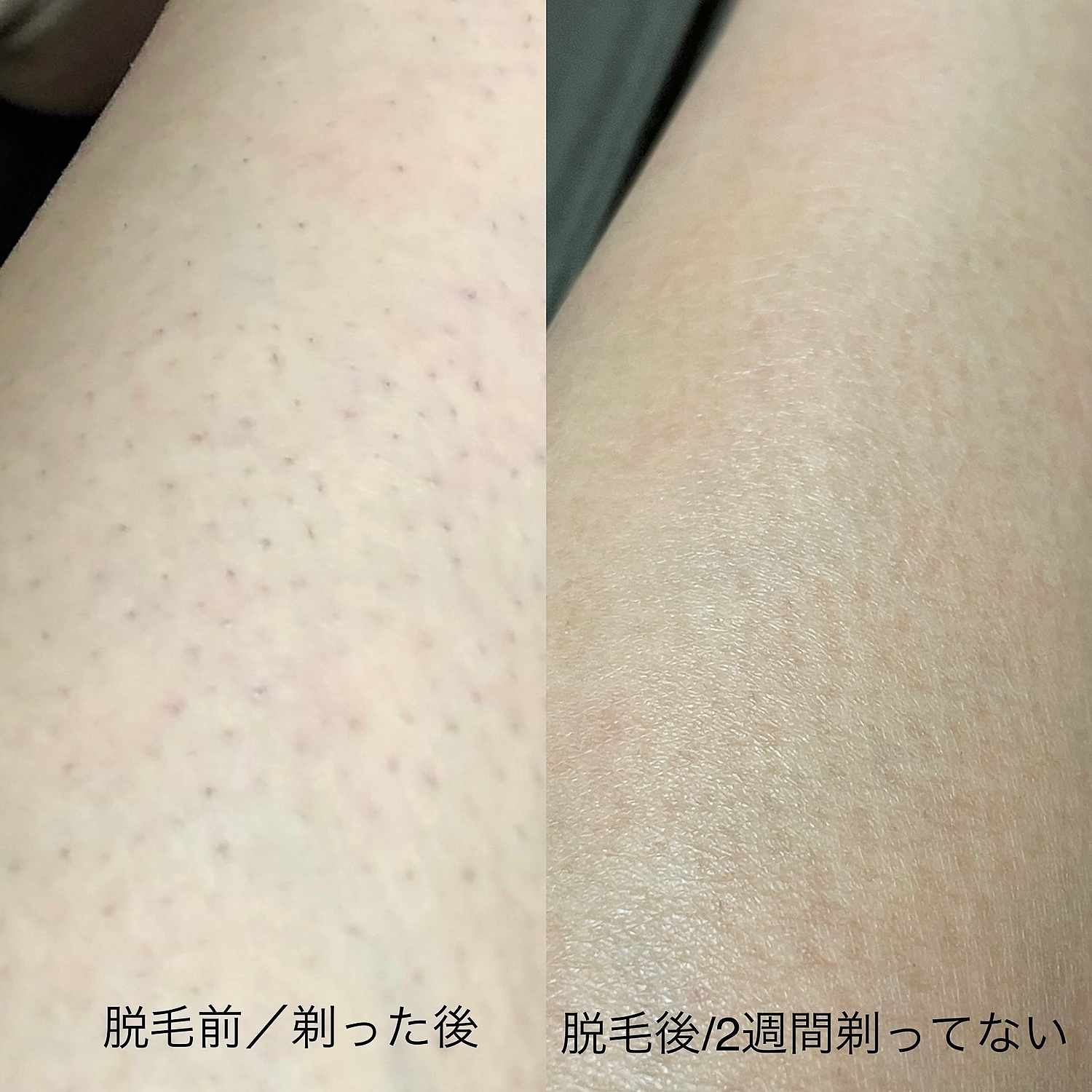 絶品】 光脱毛器 スムーズスキン pure fit SMOOTHSKIN サロン