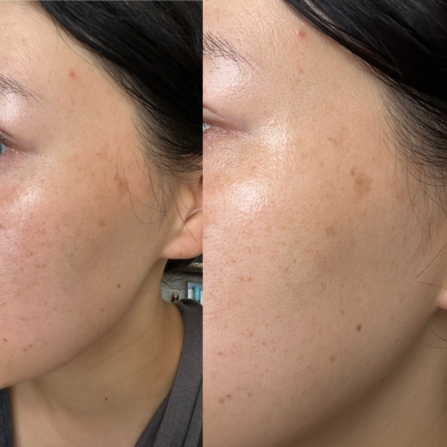 楽天市場】【累計45万個 シミのスピードケア】シミ取りクリーム シミ