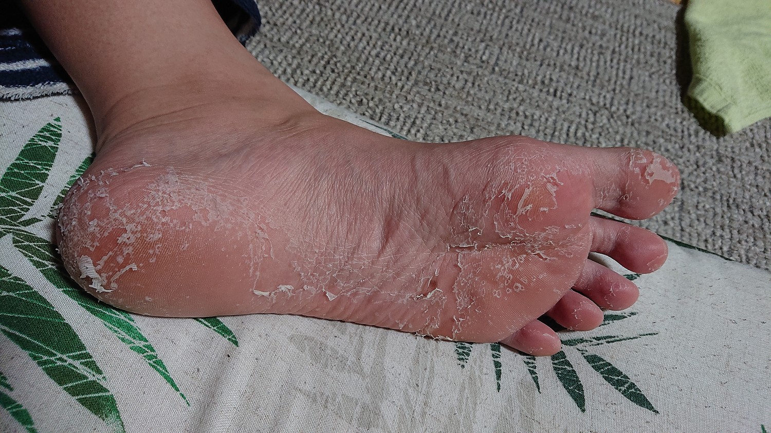 皮 むける が お 裏 足 上がり 風呂 の 落屑（らくせつ）乾燥した皮膚がボロボロと落ちる