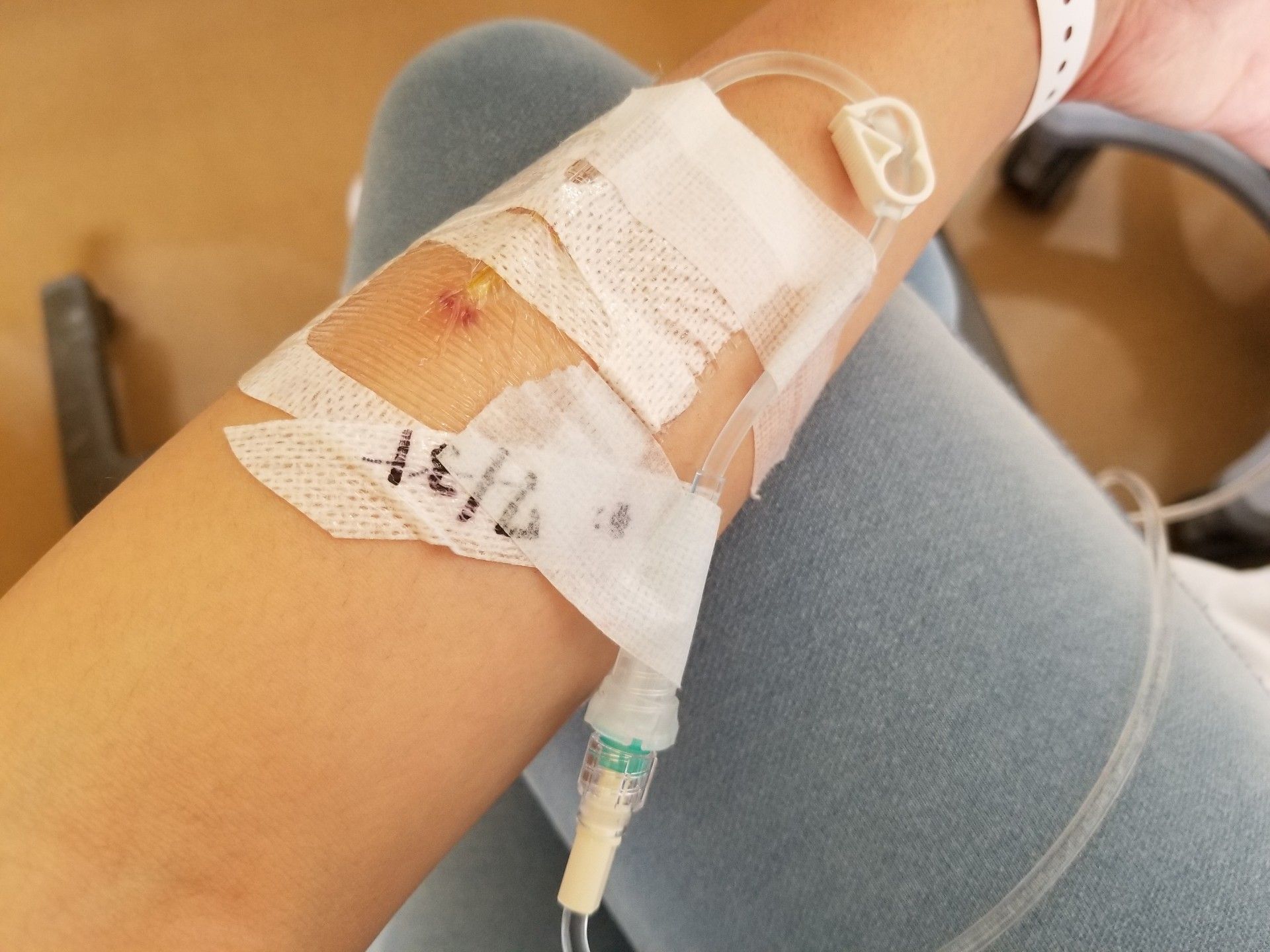 ステロイドパルス療法の副作用について 代 多発性円形脱毛症に負けない ３児ママ 楽天ブログ