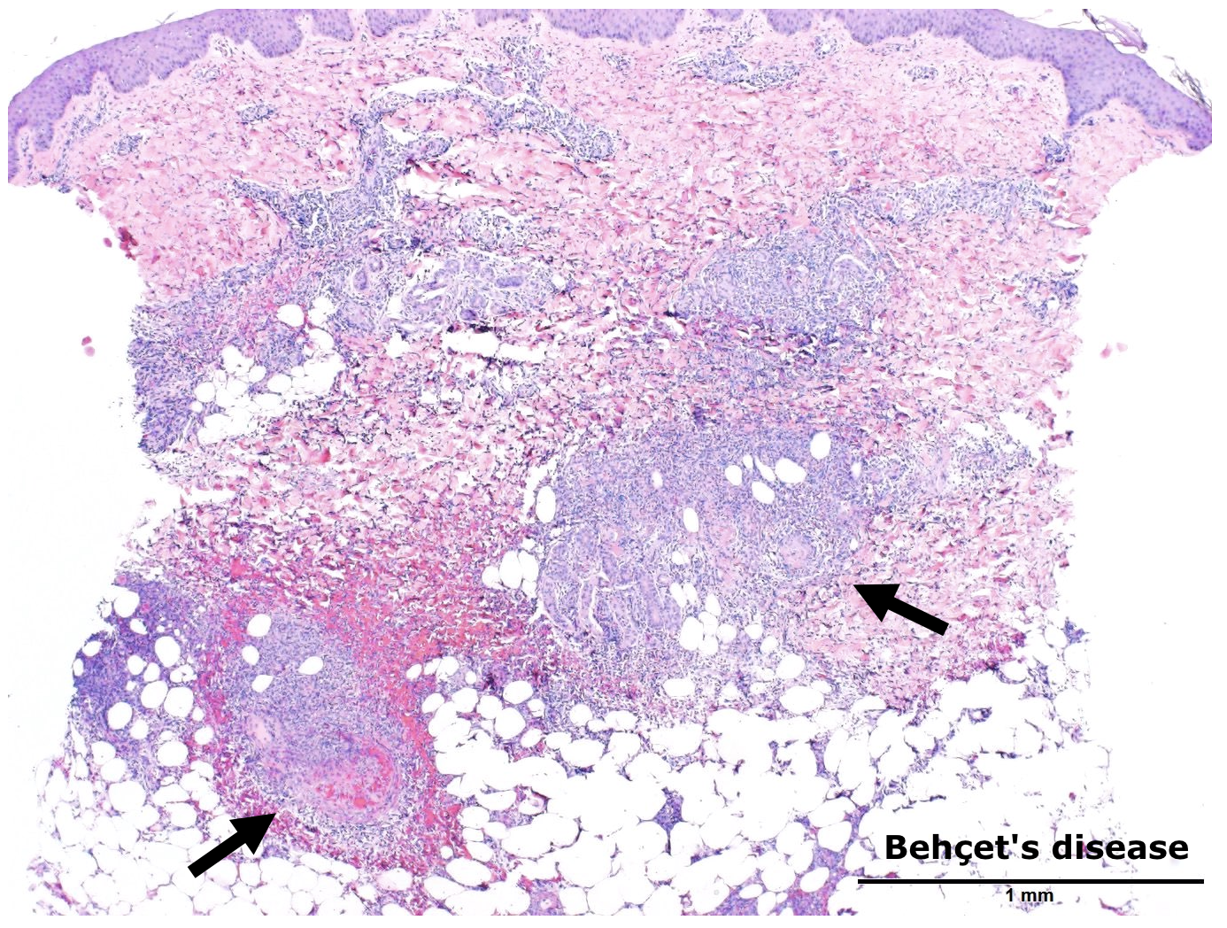 血栓性静脈炎を予防するにはどうすればよいですか?