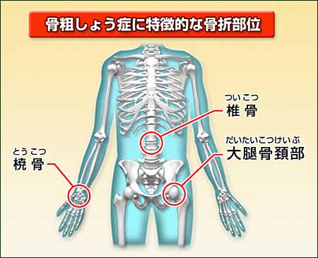 骨折しやすい部位.jpg