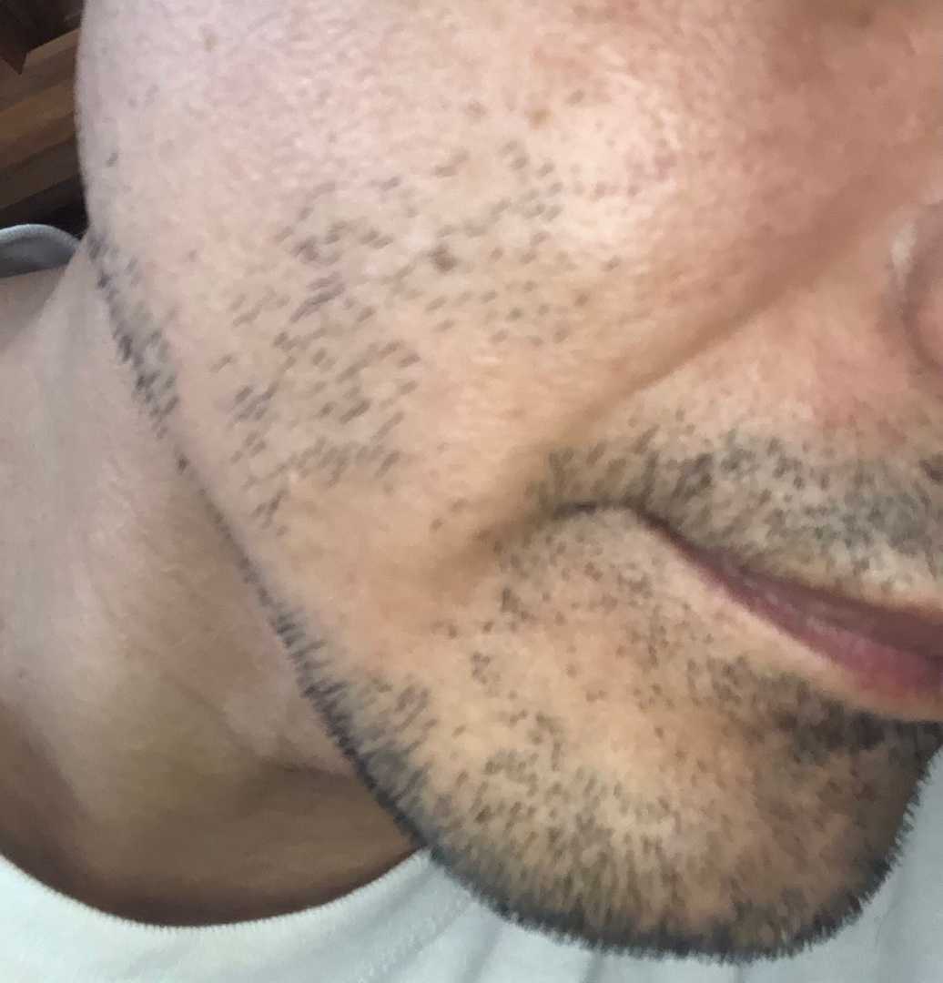 脱毛 ４６歳オッサンが格好良いオジサンになる為に頑張るブログ 楽天ブログ