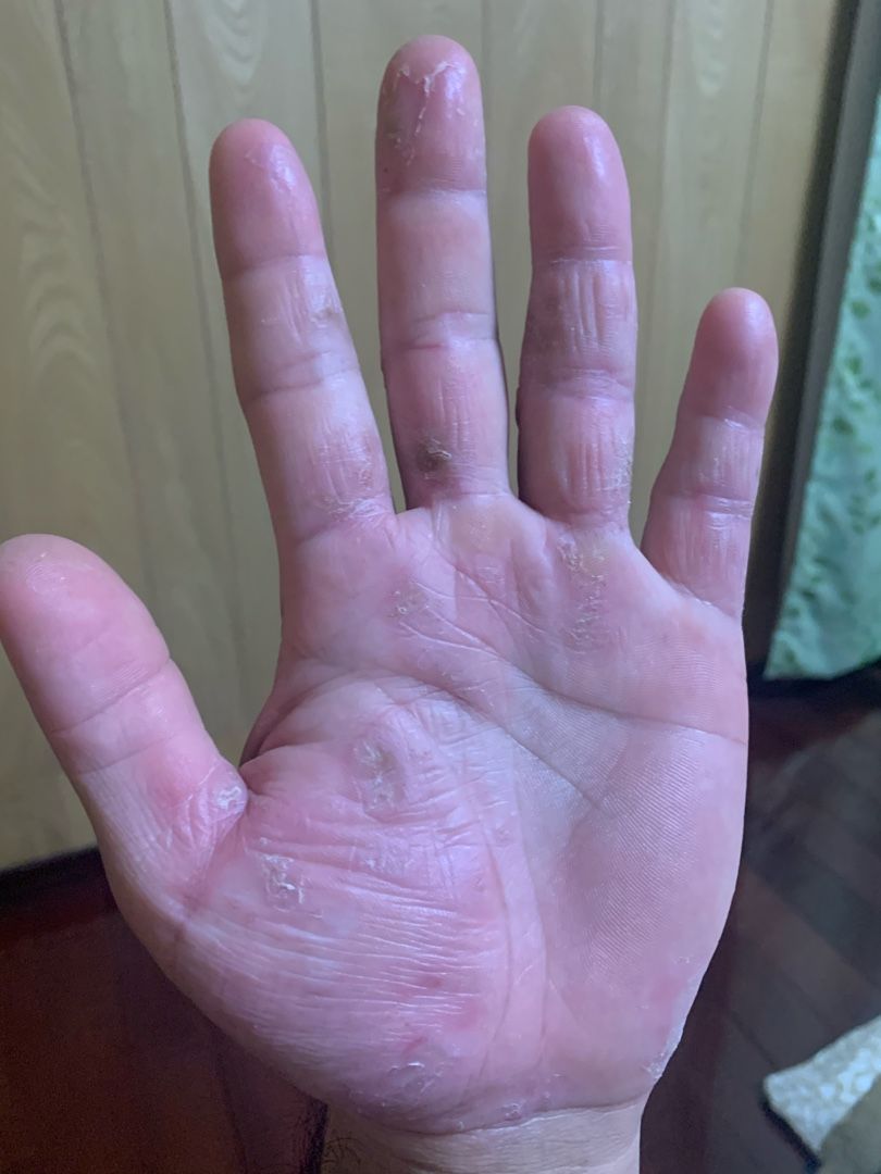 手湿疹 釣りやらなんやらブログ 楽天ブログ