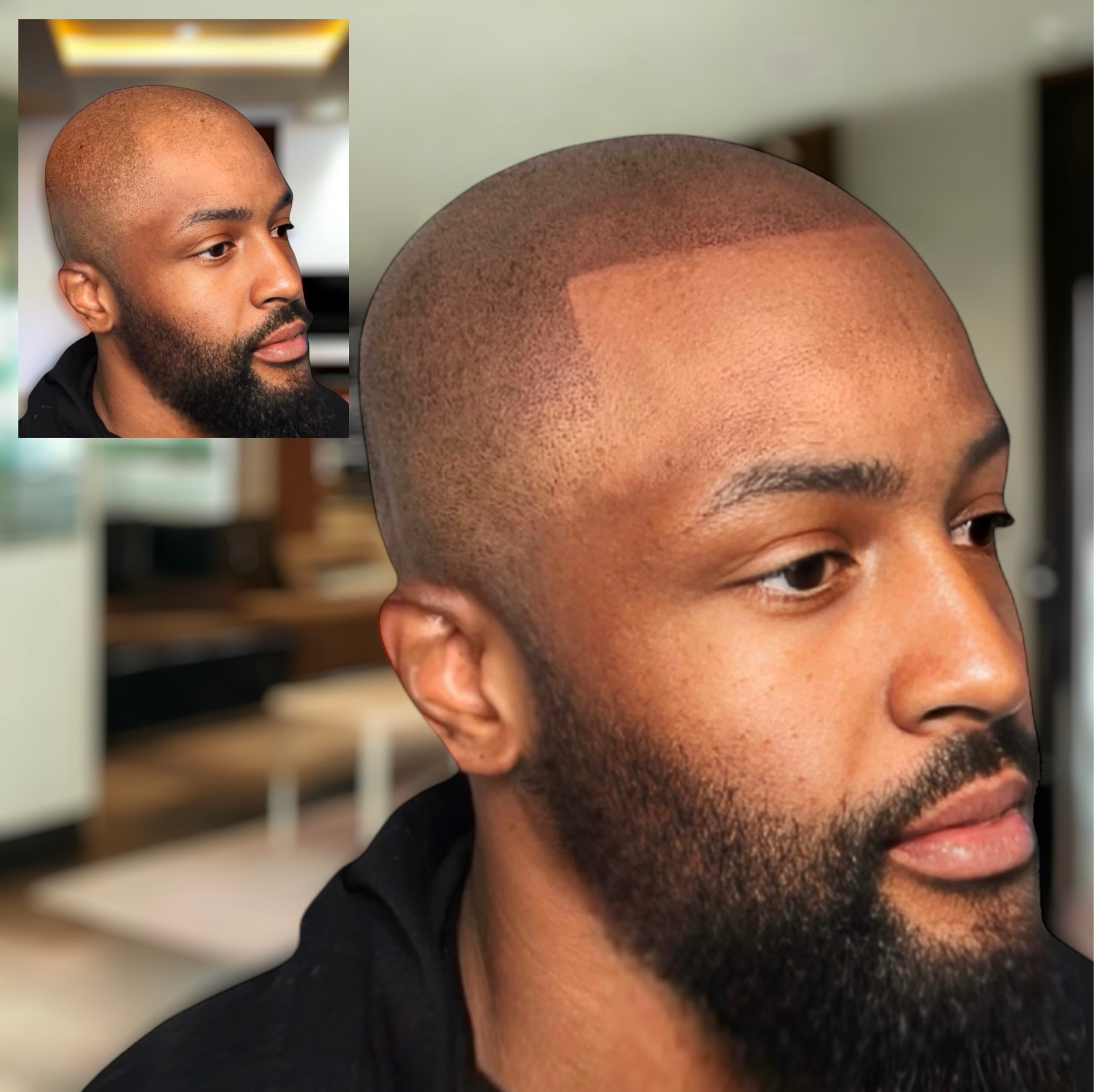 How Scalp Micropigmentation Transforms Hair | Enfield Royal Clinic Abu ...