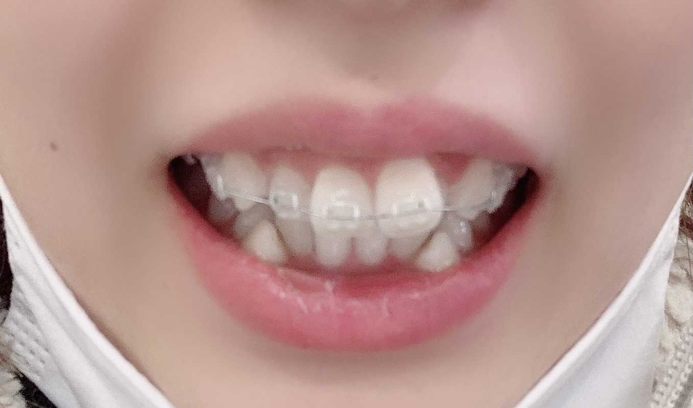 歯の矯正女子始めました ホヌののんびり日記 楽天ブログ