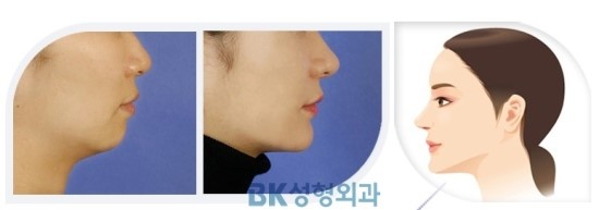 小さい顎(小顎症)韓国/美容整形/BKトンヤン/BK美容外科 韓国美容外科-BK美容外科のブログ 楽天ブログ