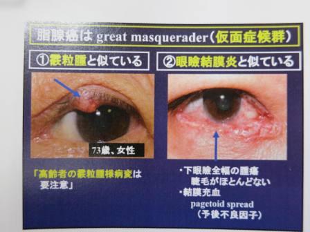 目にも癌は発生します 第6回四国eyeランドセミナー参戦記3 にしわき眼科クリニック 楽天ブログ