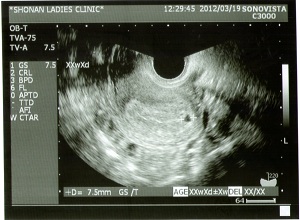 子宮外妊娠 10記事 クチコミテーマ 楽天ブログ