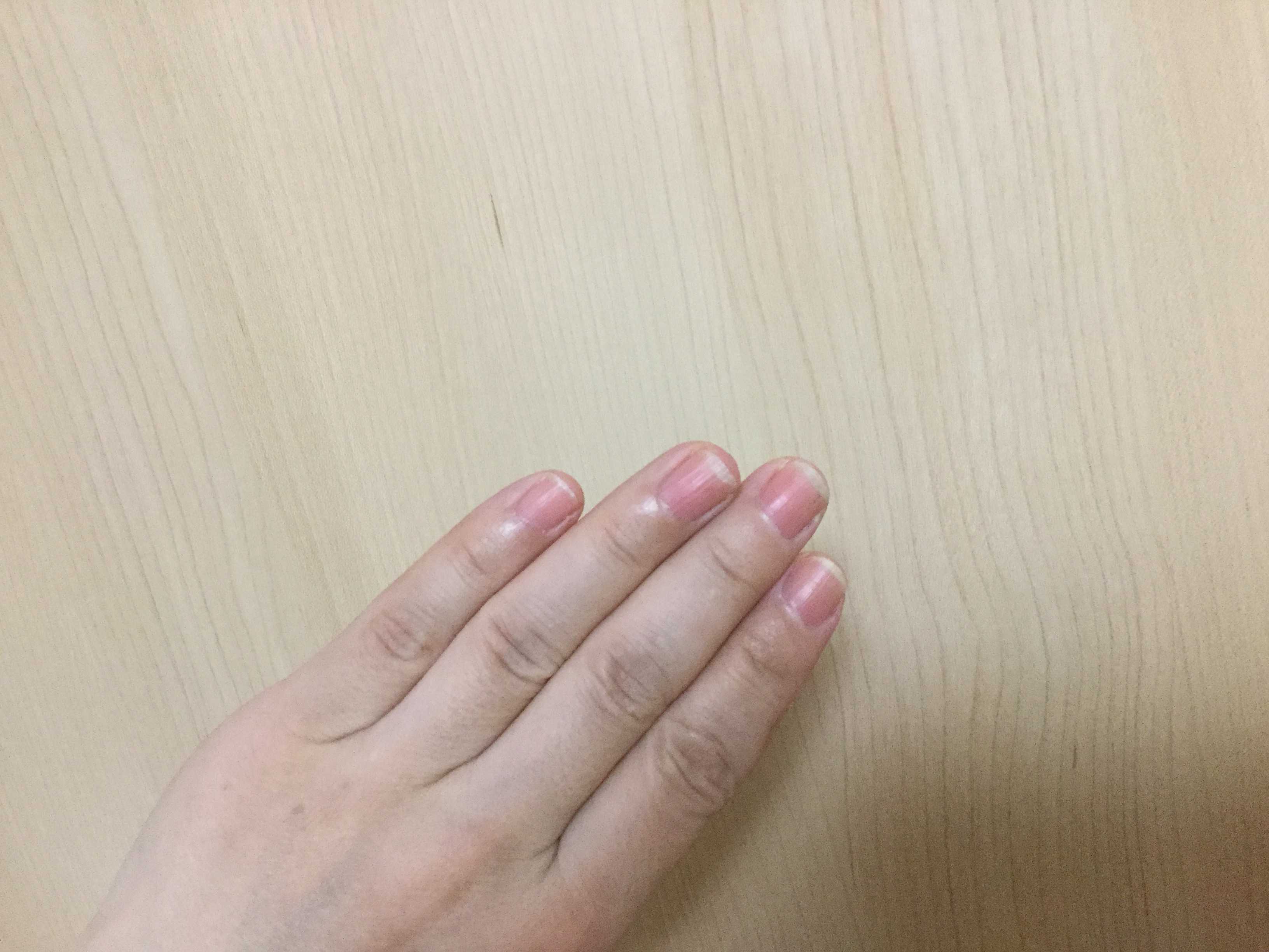 爪甲剥離完治までの道のり 通販 ネイル ジェルネイルアレルギーですが 楽天ブログ