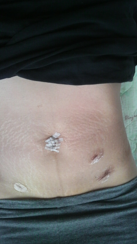 記事一覧 子宮筋腫 激痛とのタタカイ 楽天ブログ