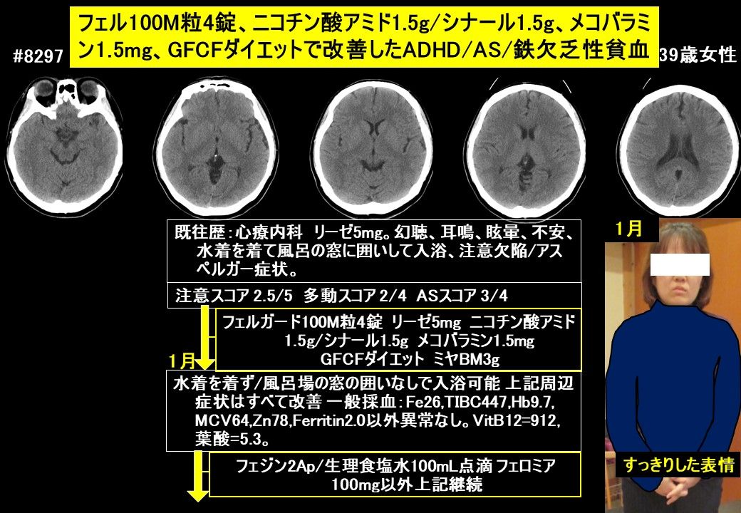 adhd 水着 安い