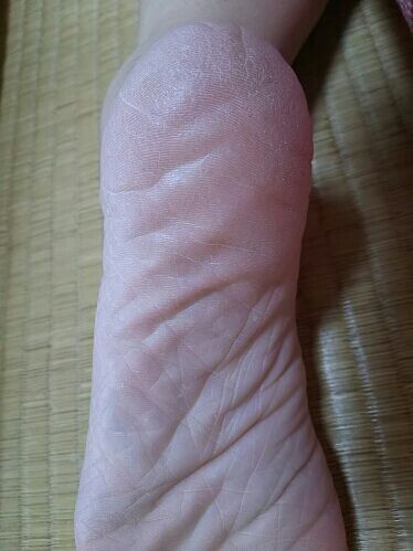 水虫治療 かかと水虫 撃退日記 楽天ブログ