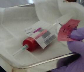 臍帯血移植が本日 無事に完了 平成２９年６月２６日 急性骨髄性白血病はじめました ２７歳で発病 楽天ブログ